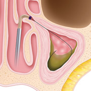 Sinus Surgery with Balloon Sinuplasty