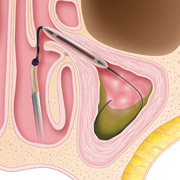 Sinus Surgery with Balloon Sinuplasty