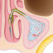 Sinus Surgery with Balloon Sinuplasty