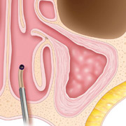 Sinus Surgery with Balloon Sinuplasty